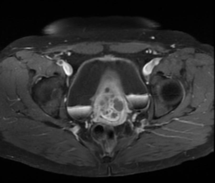 nabothian-cysts-image-radiopaedia