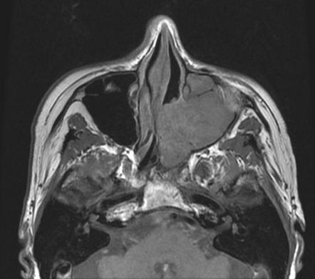 Nasopharyngeal Carcinoma Radiology Case Radiopaedia