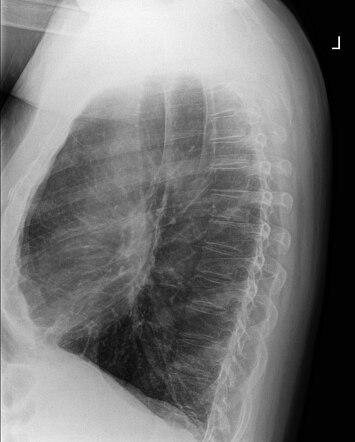 Saber-sheath trachea | Image | Radiopaedia.org