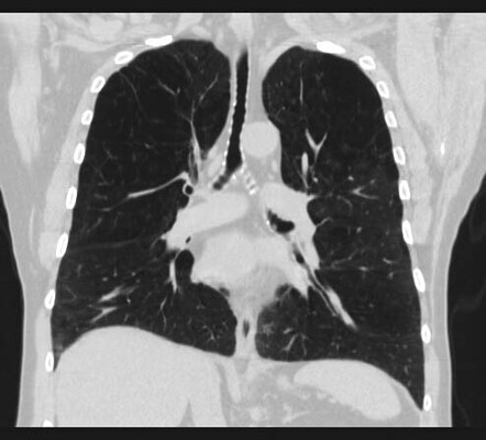 Sabre-sheath trachea | Radiology Case | Radiopaedia.org