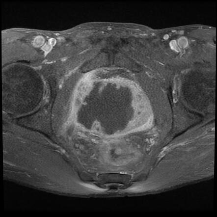 Large prostatic abscess | Radiology Case | Radiopaedia.org