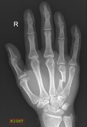 Metacarpal fracture | Radiology Case | Radiopaedia.org