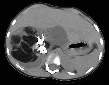 Retroperitoneal teratoma - pediatric | Image | Radiopaedia.org