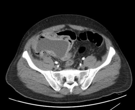 Complicated Appendicitis With Abscess Formation 