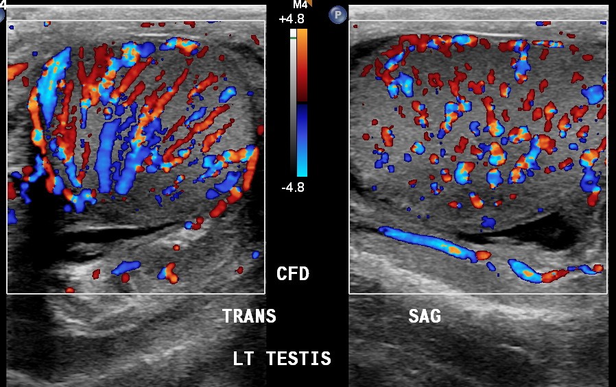 Epididymo-orchitis - acute | Image | Radiopaedia.org