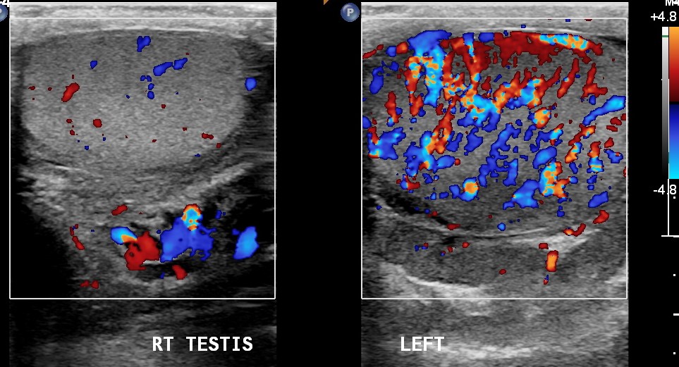 Epididymo-orchitis - acute | Image | Radiopaedia.org