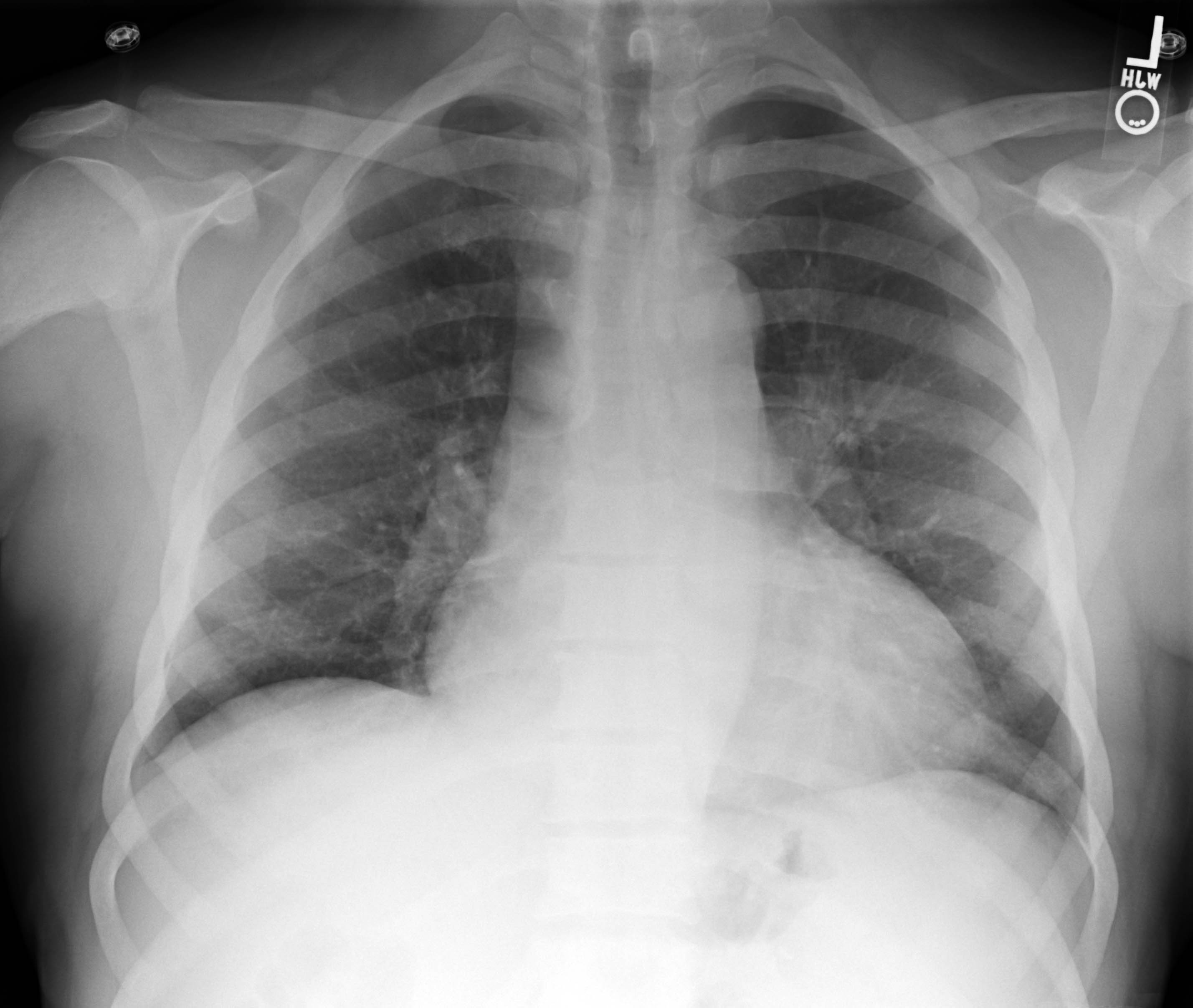 Spine and silhouette signs due to right lower lobe pneumonia | Image ...