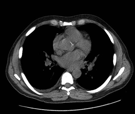 Spine and silhouette signs due to right lower lobe pneumonia | Image ...