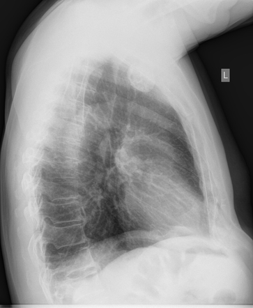 Calcified anterior mediastinal mass - thyroid nodule | Image ...