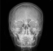 submentovertical zygomatic arches