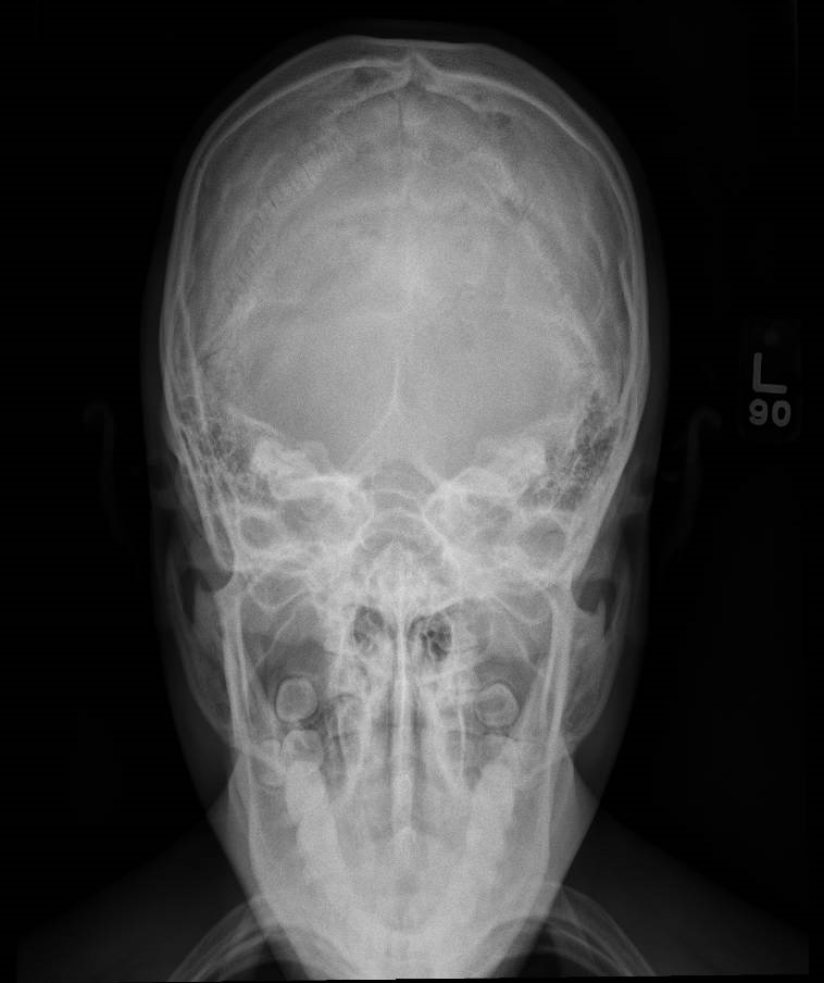 Neanderthal Zygomatic Arch