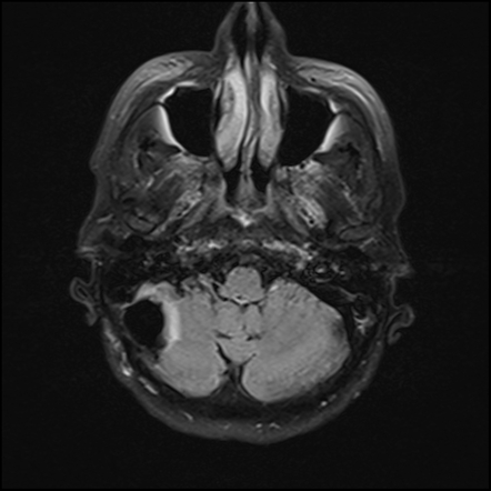 Recurrent Cerebellar Liponeurocytoma 