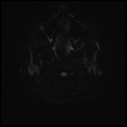 Contrast-induced neurotoxicity | Image | Radiopaedia.org