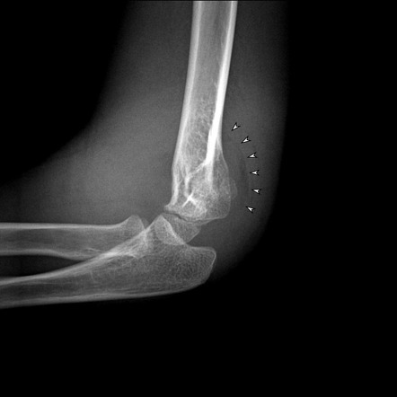 Posterior fat pad sign (elbow) | Radiology Reference Article