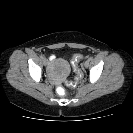 Ulcerative colitis | Radiology Case | Radiopaedia.org