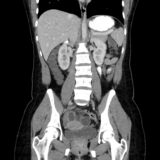 Crohns disease - terminal ileitis, fistulizing | Image | Radiopaedia.org