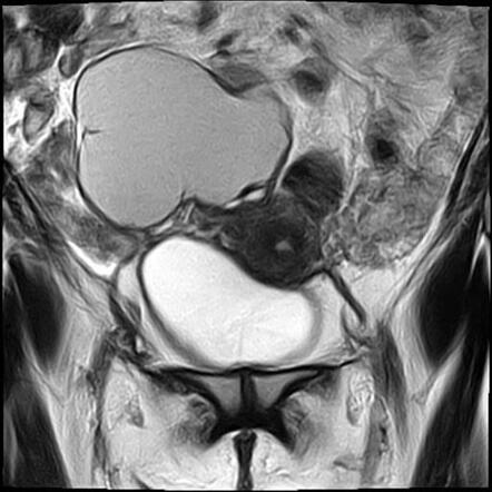 Large ovarian endometrioma | Radiology Case | Radiopaedia.org