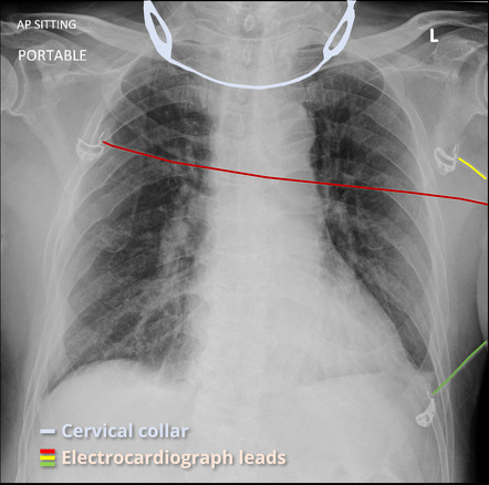 Cervical spine collar and ECG leads artifact (portable radiograph ...