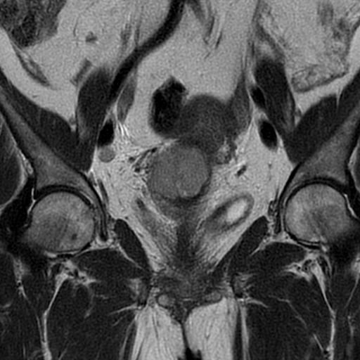 Squamous cell carcinoma of the cervix | Image | Radiopaedia.org