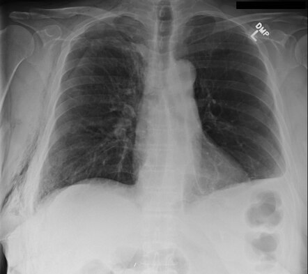 Skinfold and pneumothorax | Radiology Case | Radiopaedia.org