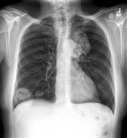 Granulomatosis with polyangiitis | Radiology Case | Radiopaedia.org