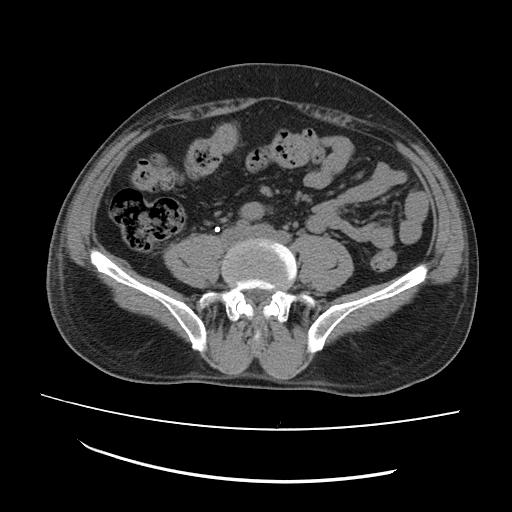 Double J stent perforating the pelviureteric junction | Image ...