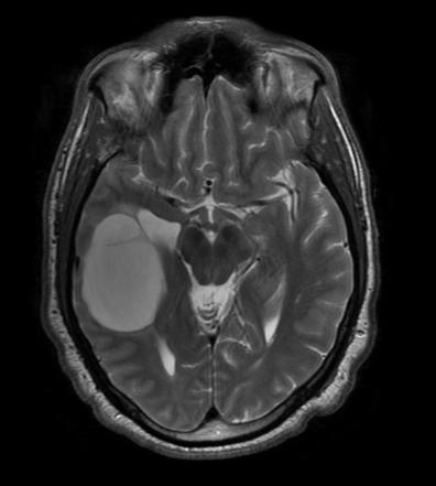 Oligodendroglioma NOS | Image | Radiopaedia.org