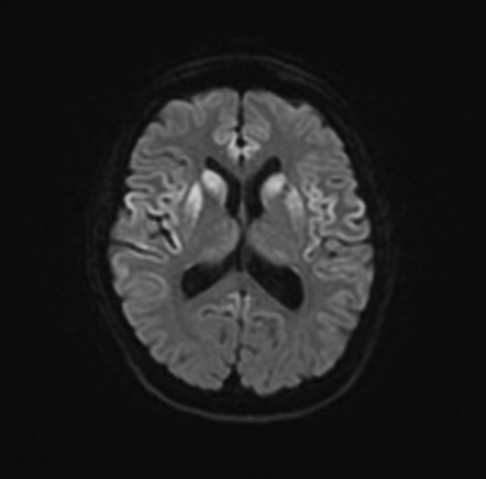 Sporadic Creutzfeld-Jakob disease | Radiology Case | Radiopaedia.org