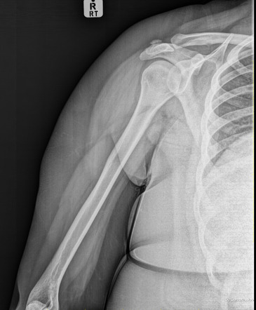 Trapezius calcific tendinosis | Radiology Case | Radiopaedia.org