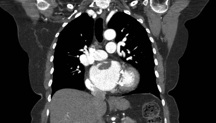 Left atrial thrombus resulting in stroke | Radiology Case | Radiopaedia.org