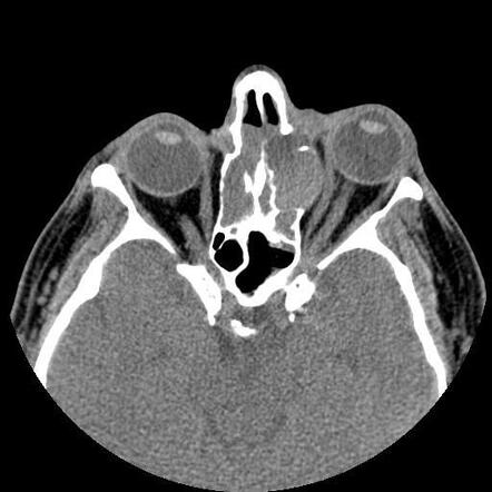 Fronto-ethmoidal sinus mucocele | Image | Radiopaedia.org