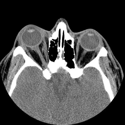 Retrobulbar hemorrhage | Image | Radiopaedia.org