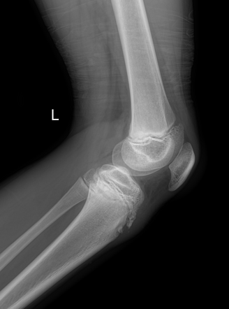 Osgood-Schlatter disease | Radiology Case | Radiopaedia.org