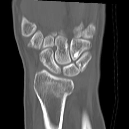 Colles fracture | Image | Radiopaedia.org