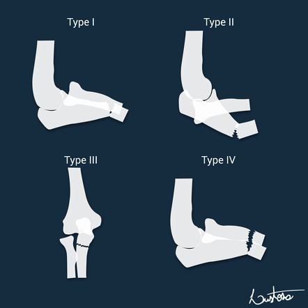 Bado Classification Of Monteggia Fracture Dislocations Image