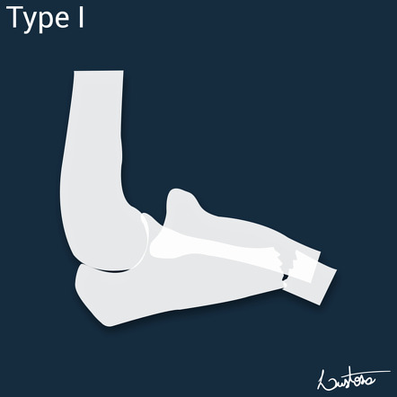 Bado classification of Monteggia fracture-dislocations | Image ...