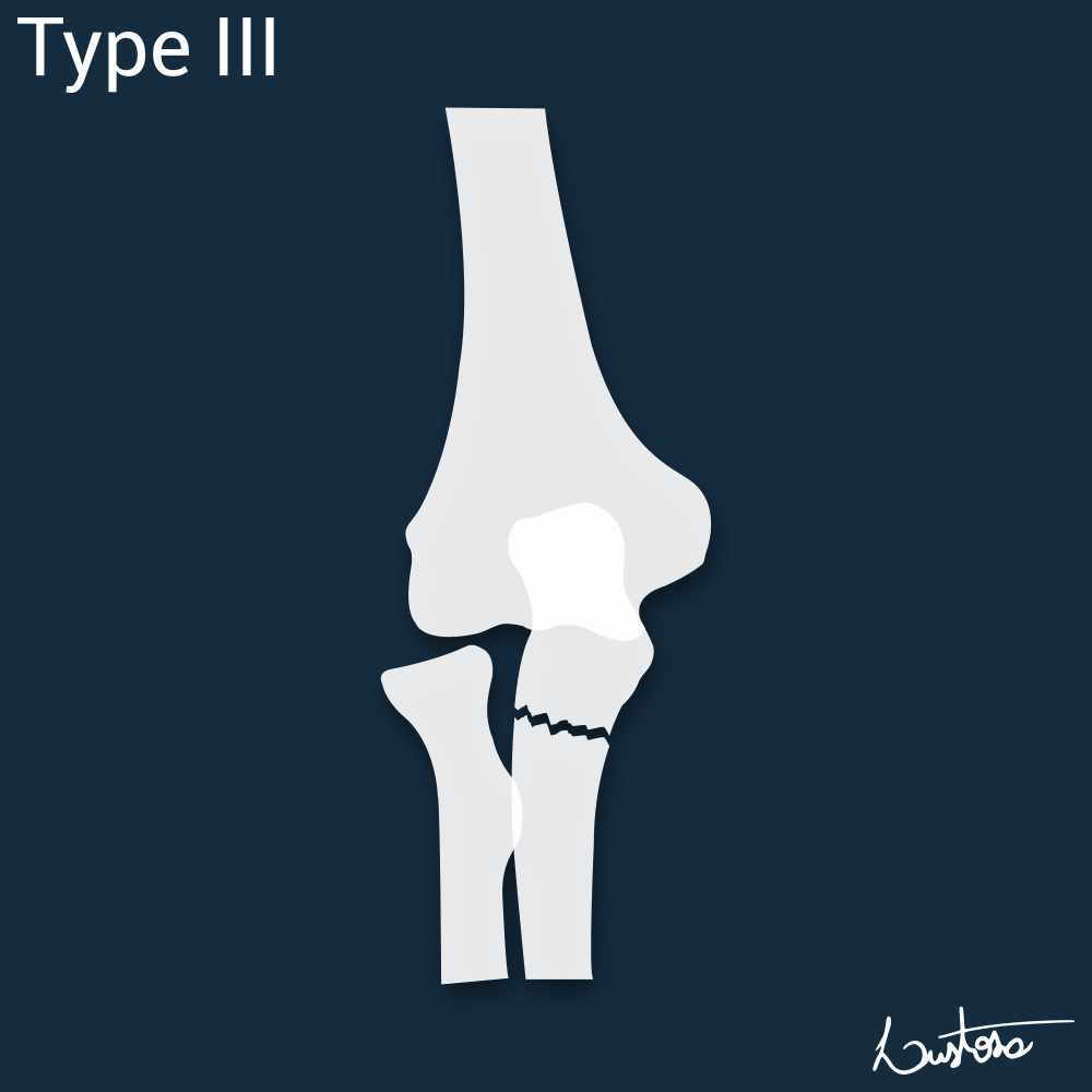 Bado classification of Monteggia fracture-dislocations | Image ...