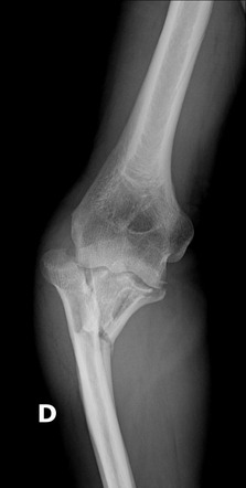 Monteggia Fracture Radiology