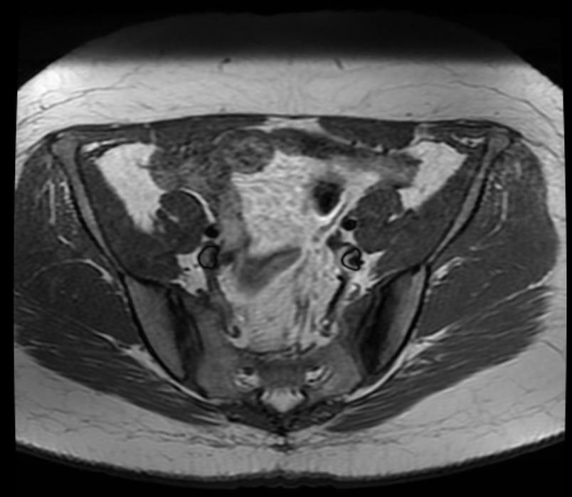 Osteitis Condensans Ilii Image