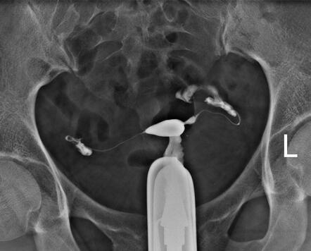 Left tubal block and hydrosalpinx | Radiology Case | Radiopaedia.org