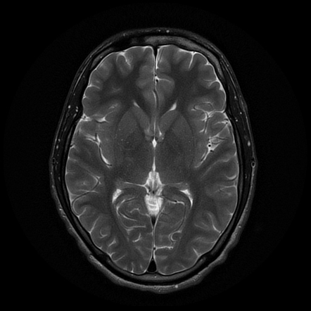 Polymorphous low-grade neuroepithelial tumor of the young | Radiology ...