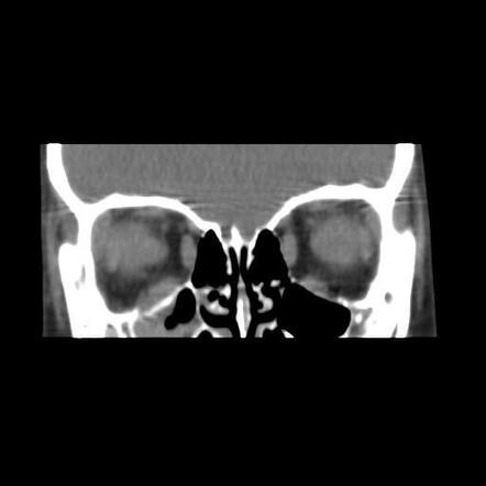 Orbital blow-out fracture | Radiology Case | Radiopaedia.org