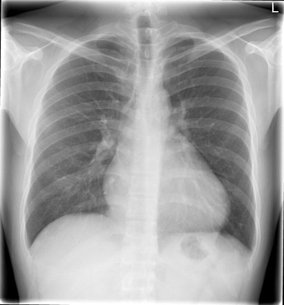 Pink tetralogy of Fallot | Radiology Case | Radiopaedia.org