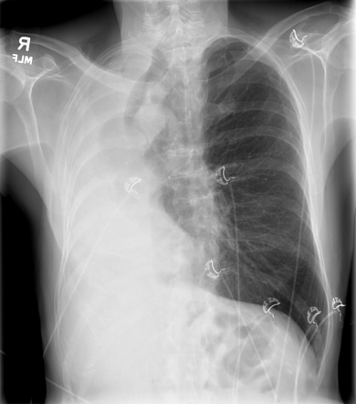 Right lung atelactasis due to endobronchial cancer | Radiology Case ...