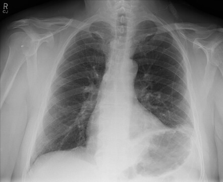 Phrenic nerve palsy | Radiology Reference Article | Radiopaedia.org