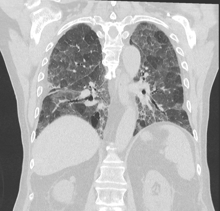 Methotrexate lung disease | Radiology Reference Article | Radiopaedia.org