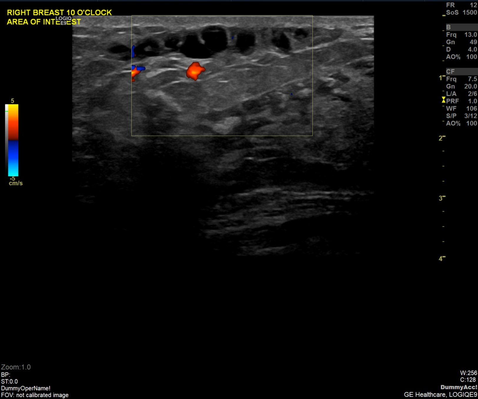 Mondor Disease Breast Image