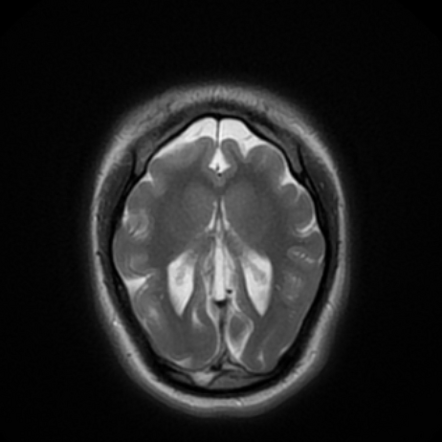 Microcephaly with a simplified gyral pattern | Radiology Reference ...