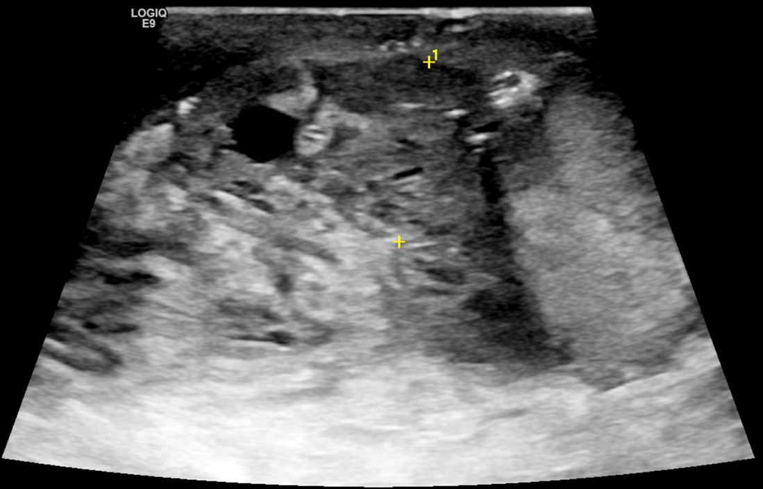 Segmental Testicular Infarction Following Epididymo Orchitis Image