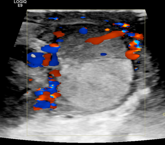 Segmental Testicular Infarction Following Epididymo Orchitis Image